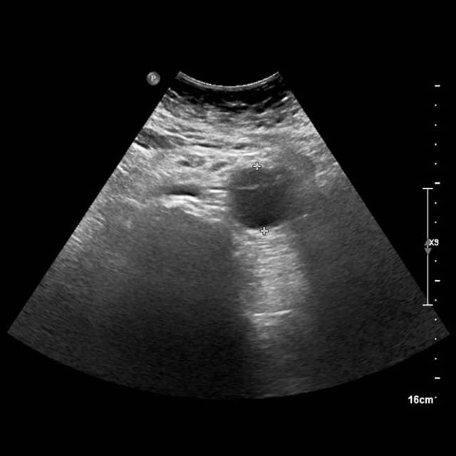 Chirofisiogen-CenterEcocolordoppler-Aorta-Addominale-min.jpg